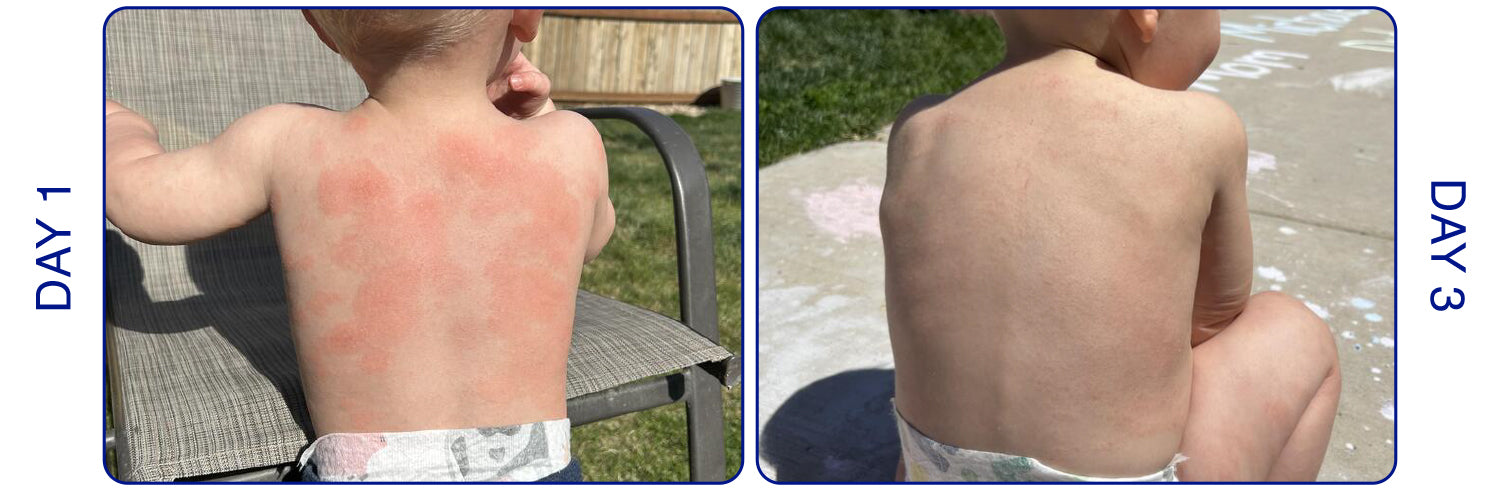 When Your Child's Skin Is Red, Irritated, or Miserable, Relief Can't Wait