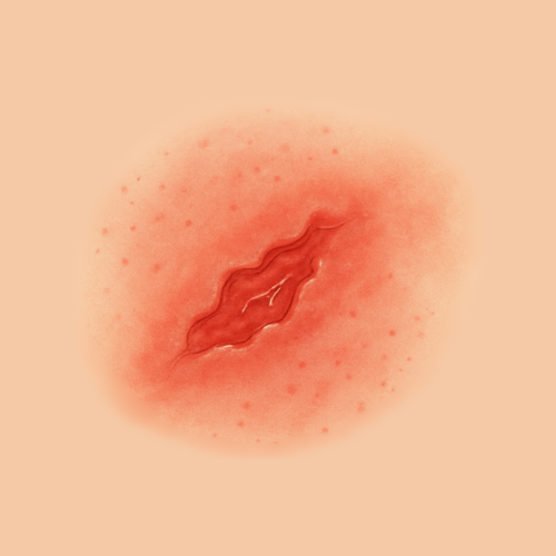 Drawn image of a wound