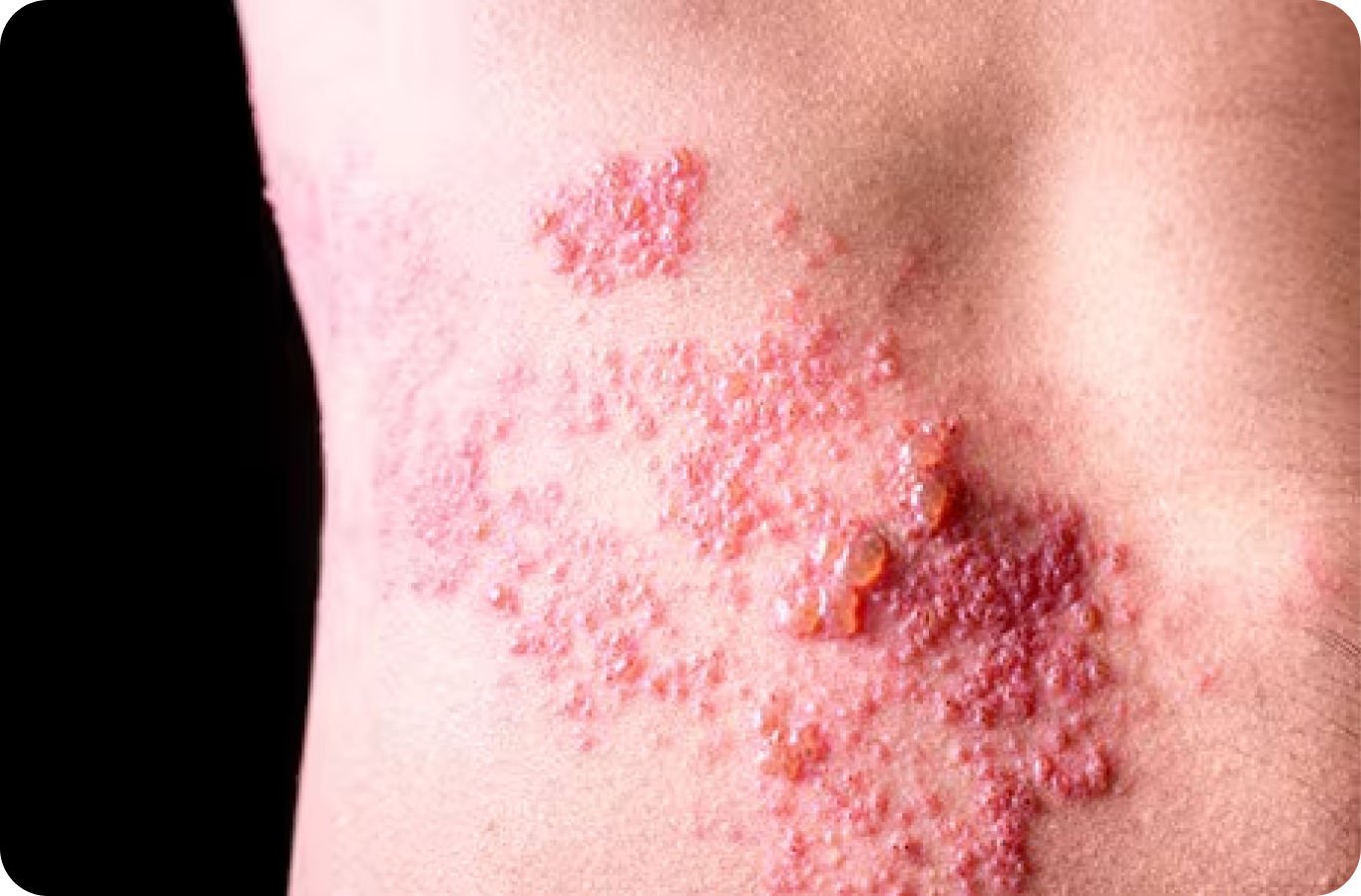 Do You Suffer from Shingles?