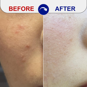 before and after acne treatment comparison