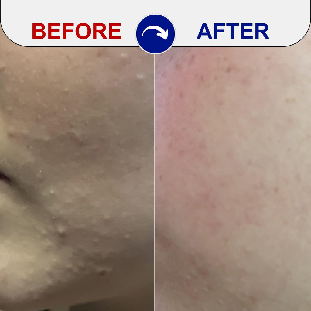 before and after skincare treatment results before and after skincare treatment results