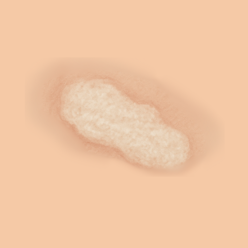 Drawn image of lichen sclerosus
