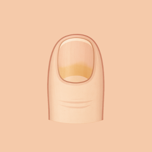 Drawn image of nail fungus