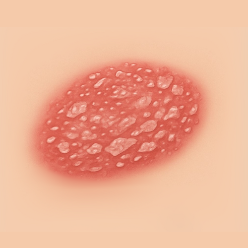 Drawn image of a psoriasis
