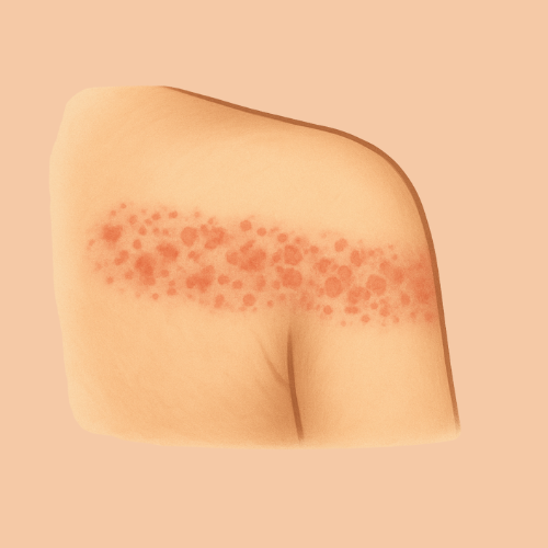 Drawn image of a rash across the shoulder