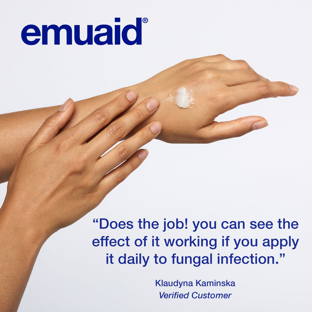 applying emuaid cream on hand for fungal infection