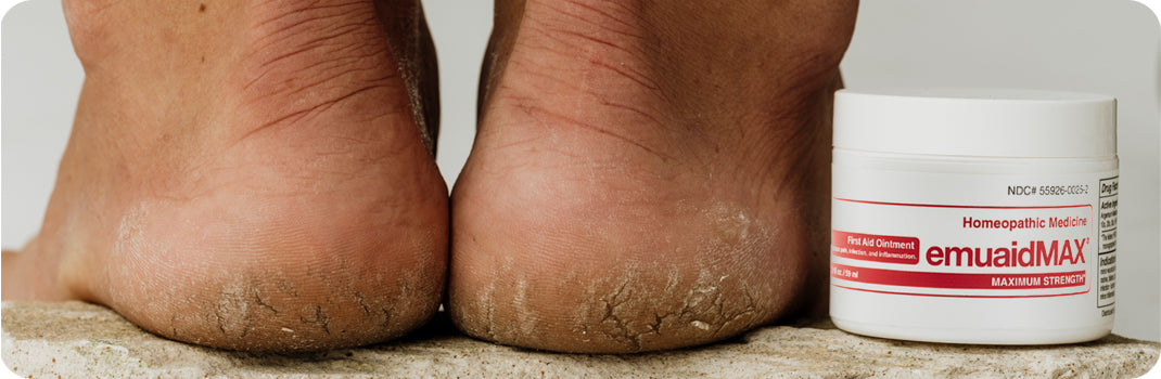 EMUAID Kills Pathogens and Eliminates Plantar and Palmer Warts without Freezing or Burning*