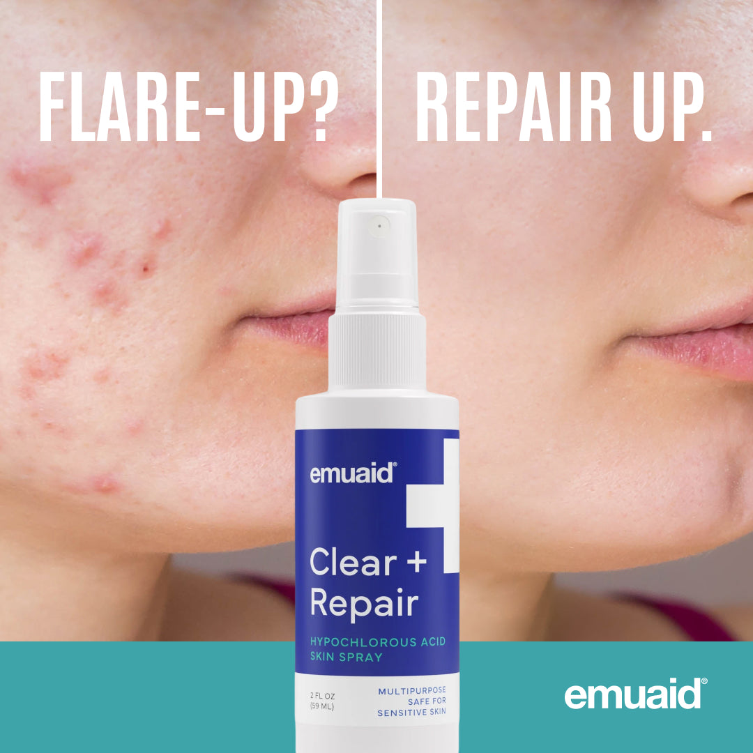 Flacone spray per la pelle Emuaid + Repair con immagini del viso di una persona prima e dopo il trattamento contro l'acne.