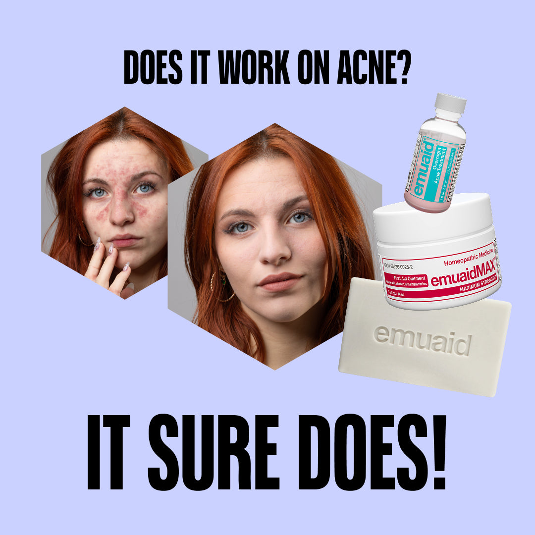 Illustration promotionnelle des emuaid présentant une comparaison avant-après de l'acné sur fond violet.