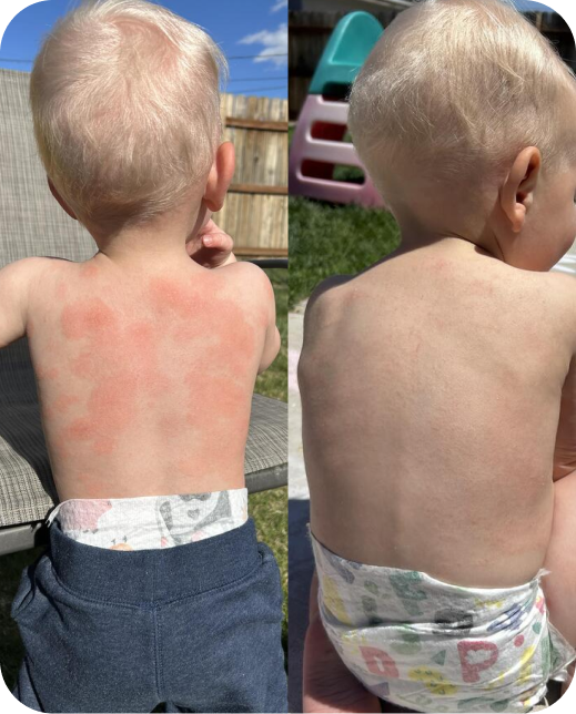 Eczema before after comparison