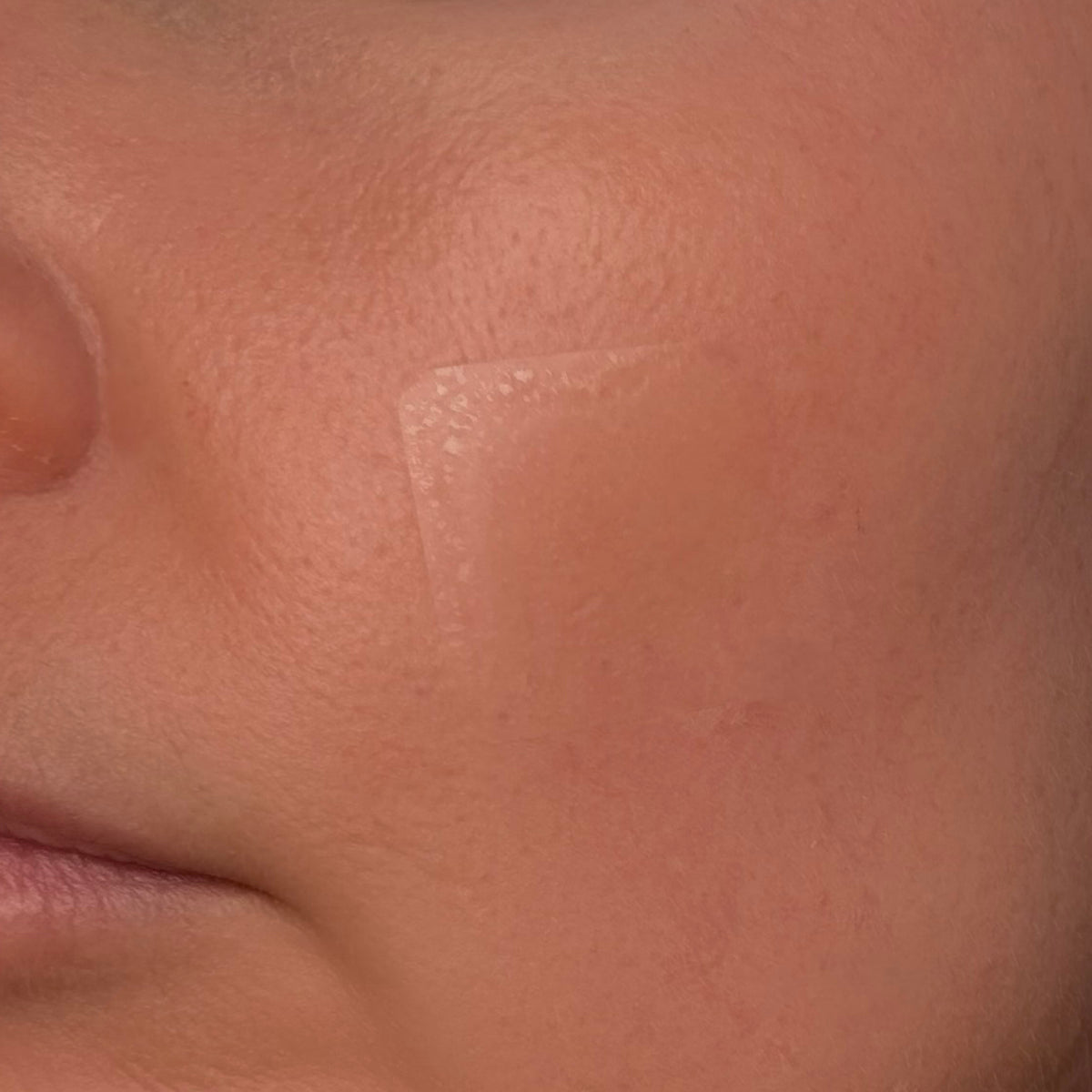 EMUAIDMAX Hydrocolloid Patches