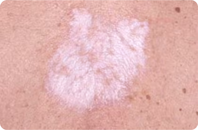 Do You Suffer from Lichen Sclerosus?
