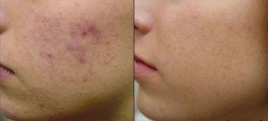 Comparación del antes y el después del acné en el rostro de una persona.