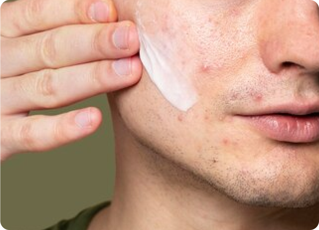 EMUAID Acne Erasing System
