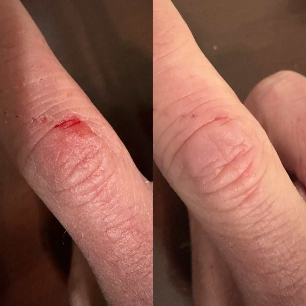 Nahaufnahme einer Schnittwunde am Finger vor und nach der Heilung.
