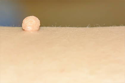 A picture of a skin tag