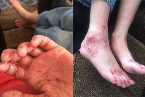 A picture of eczema skin