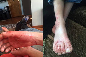 A picture of eczema skin