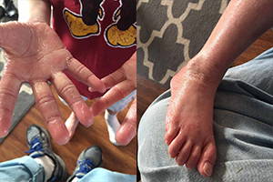 A picture of eczema skin